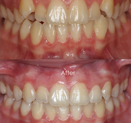 Before & After 1 Before and After image of teeth cleaning