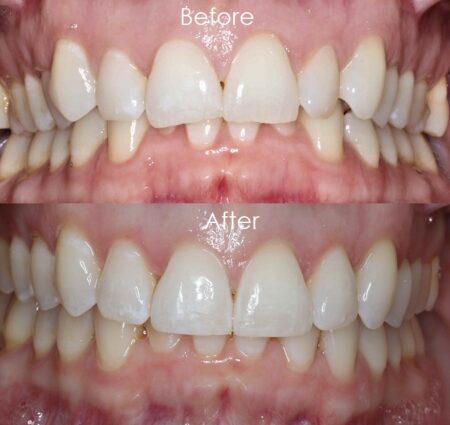 Before & After 2 Before and After of white teeth
