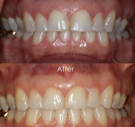 Before & After 3 Before and After of images of teeth