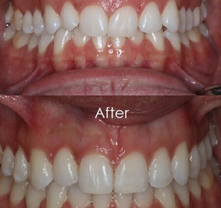 Before & After 6 Before and After images of an Okanagan Smiles client