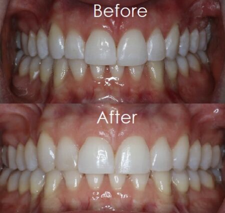 Before & Atfer 7 Before and After image of an Okanagan Smiles client